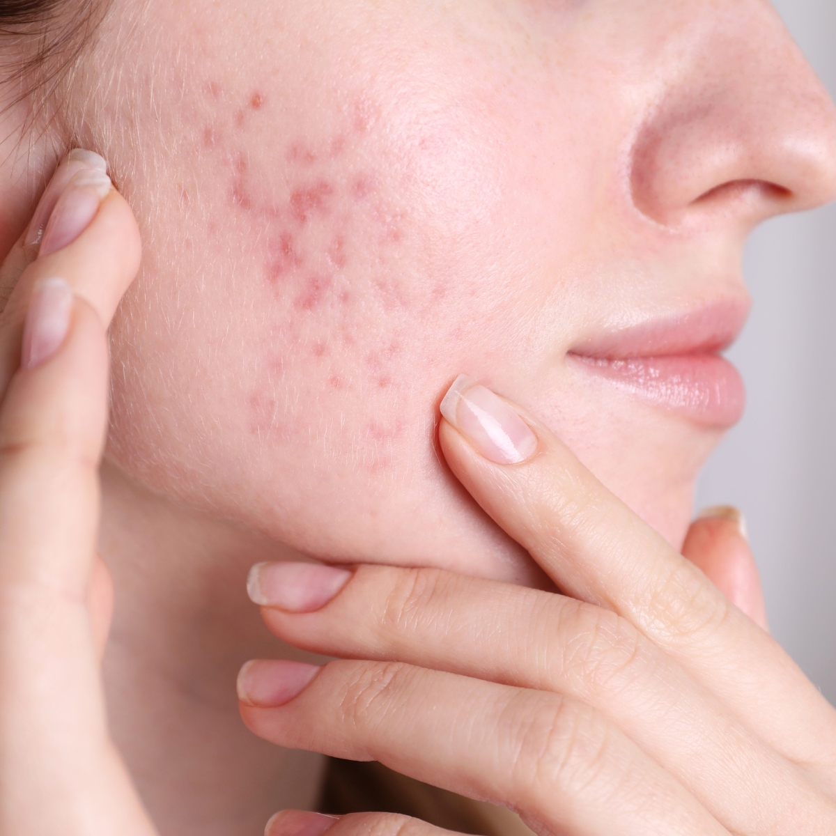 Fraxel cicatrici da acne