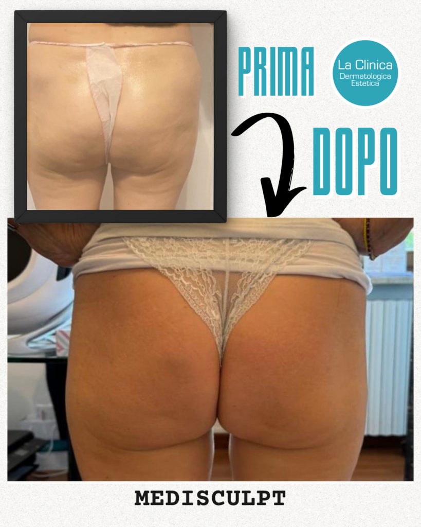 prima-dopo medisculpt - lcde ok